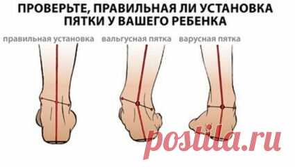 «Вальгусная и варусная деформация коленных суставов: лечение и профилактика  Для вальгусной деформации коленного сустава характерно аномальное положение коленей внутрь, прижимаясь друг к другу, а вот для варусной ... Лечение таких деформаций в первую очередь ... » — карточка пользователя мартина м. в Яндекс.Коллекциях