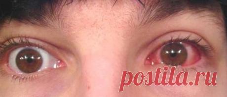 Лечение конъюнктивита народными средствами.