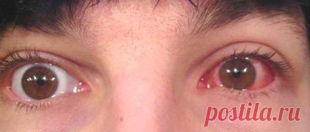 Лечение конъюнктивита народными средствами.