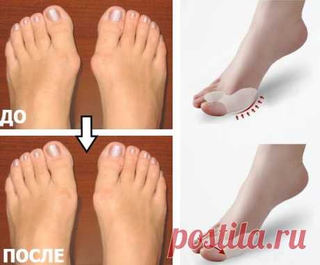 Мучатся от боли или жить комфортно? 4-х шаговая инструкция по лечению косточки за 30 дней!