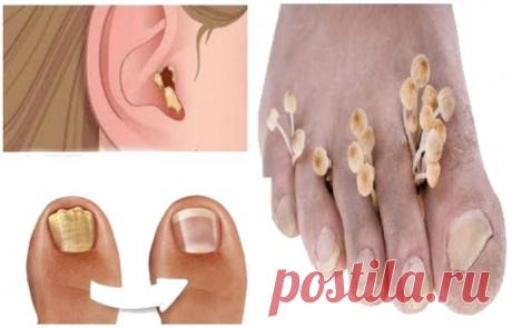 Уникальный природный ингредиент для удаления всех видов грибка на коже - Советы на каждый день
