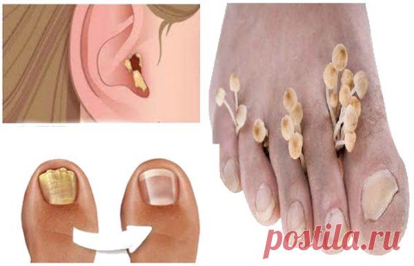 Уникальный природный ингредиент для удаления всех видов грибка на коже - Советы на каждый день