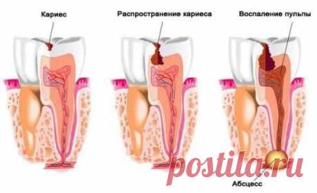 Профилактика кариеса – как остановить и предотвратить кариес зубов