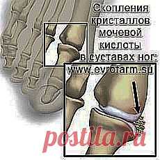 ПОДАГРА И ПОДАГРИЧЕСКИЙ АРТРИТ. НАРОДНЫЕ МЕТОДЫ ЛЕЧЕНИЯ ПОДАГРЫ.