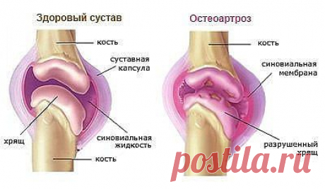 Болят колени, лечение народными средствами