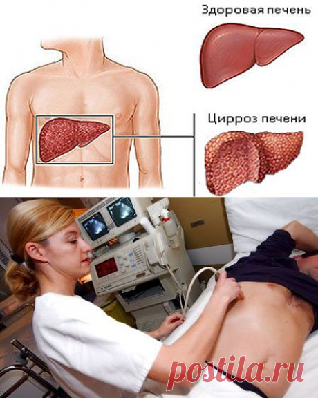 Цирроз печени: причины, симптомы и лечение
