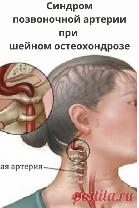Изменение кровотока по позвоночным артериям вызывает головную боль, особенно в затылке, головокружение, нарушение зрения, координации движений.
