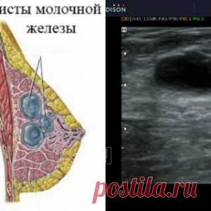 Домашнее средство всего из двух ингредиентов поможет избавиться от кисты молочной железы