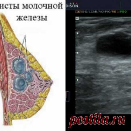 Домашнее средство всего из двух ингредиентов поможет избавиться от кисты молочной железы