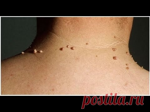 #Родинка   #Папилома   #Полип   #Бородавка