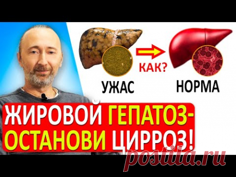 ГЕПАТОЗ ПЕЧЕНИ есть у 70% людей: 5 причин! Диагностика и лечение больной, жирной Печени!