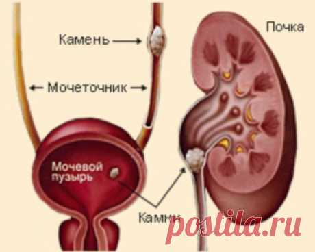 Oчищаем почки от &quot;песка&quot; и &quot;камней&quot;