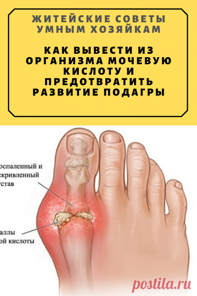 Как вывести из организма мочевую кислоту и предотвратить развитие подагры | Житейские Советы