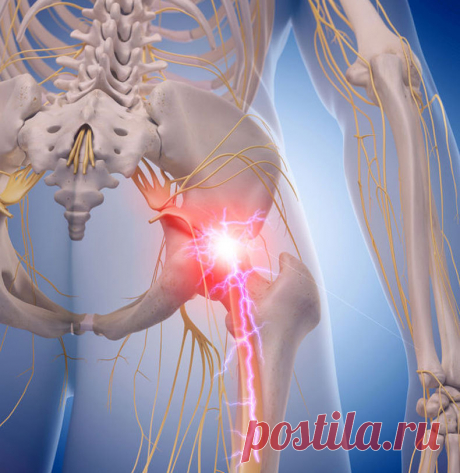 Как снять боль при защемлении седалищного нерва Многие люди по утрам сталкиваются с ощущением покалывающих или тупых болезненных ощущений в бедрах или голенях.