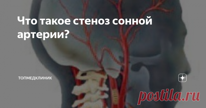 Что такое стеноз сонной артерии? На стеноз сонной артерии приходится около 30% случаев инсульта. Диагностика, лечение и своевременное предотвращение