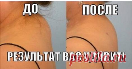 Как избавиться от ХОЛКИ!!! Всего несколько процедур и будет гибкой и красивой! смешать в стакане 3 ст.л. оливкового масла и 1 сырое куриное яйцо, добавить столько же по объему скипидара и 6% столового уксуса, снова перемешать и на 15-20 минут накладывать мазь на «холку». Затем смыть теплой водой. Пройдя несколько процедур, вы почувствуйте огромную разницу!