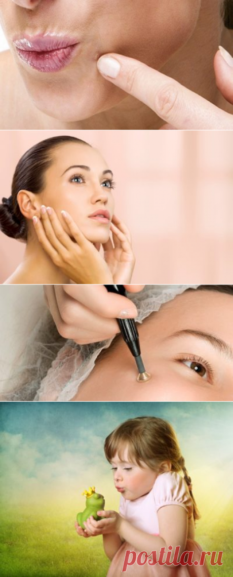 Как избавиться от бородавок в домашних условиях за 1 день