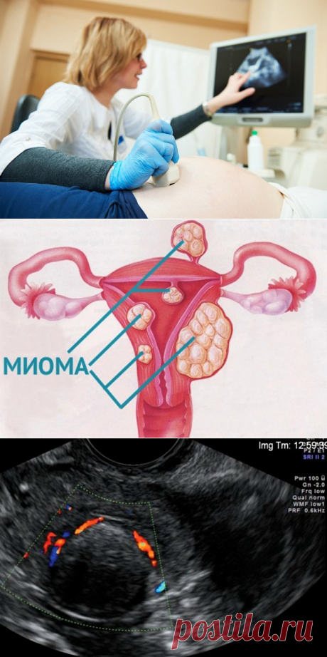 Миома матки на УЗИ: на какой день цикла лучше делать, как подготовиться, как выглядит на фото, расшифровка заключения, что такое неоднородный миометрий