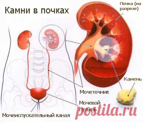 КАМНИ В ПОЧКАХ. РЕЦЕПТЫ НАРОДНОЙ МЕДИЦИНЫ ПРИ ЗАБОЛЕВАНИЯХ ПОЧЕК (ПОЧЕЧНОКАМЕННОЙ И МОЧЕКАМЕННОЙ БОЛЕЗНЯХ)