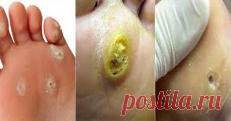 1 мазь моментально удалит натоптыши и мозоли! Смотрите наше видео!