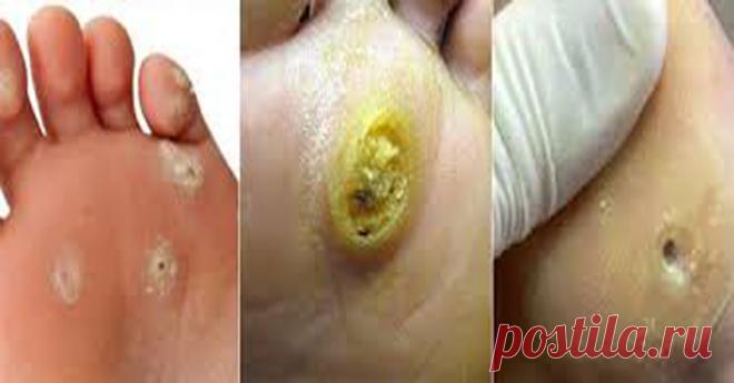 1 мазь моментально удалит натоптыши и мозоли! Смотрите наше видео!