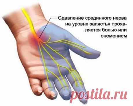Туннельный синдром и упражнения для кистей рук