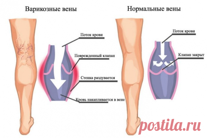 Самые эффективные упражнения против варикоза