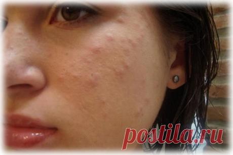 Лечение угревой сыпи.