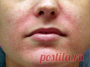 #Микоз – как лечить грибок кожи
Микоз (дерматомикоз) – что это? Как лечить грибок кожи. Чем опасны грибковые заболевания кожи. Лечение грибка народными средствами.