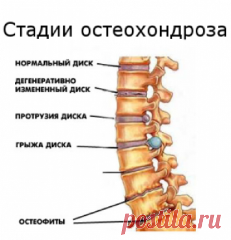 Лечение остеохондроза в домашних условиях народными средствами ...