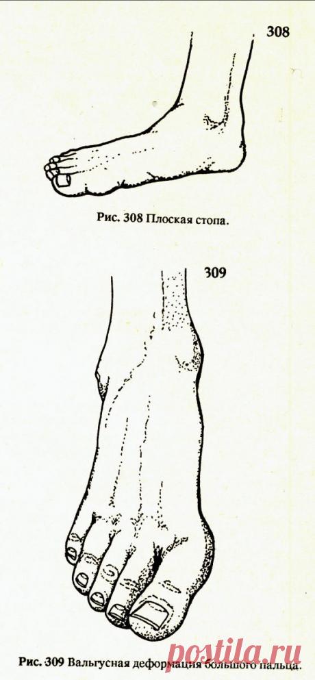 Мануальная терапия при патологии &quot;халюс-вальгус&quot;. | Официальный сайт Л. Розломия | Розломий Леонид Кононович