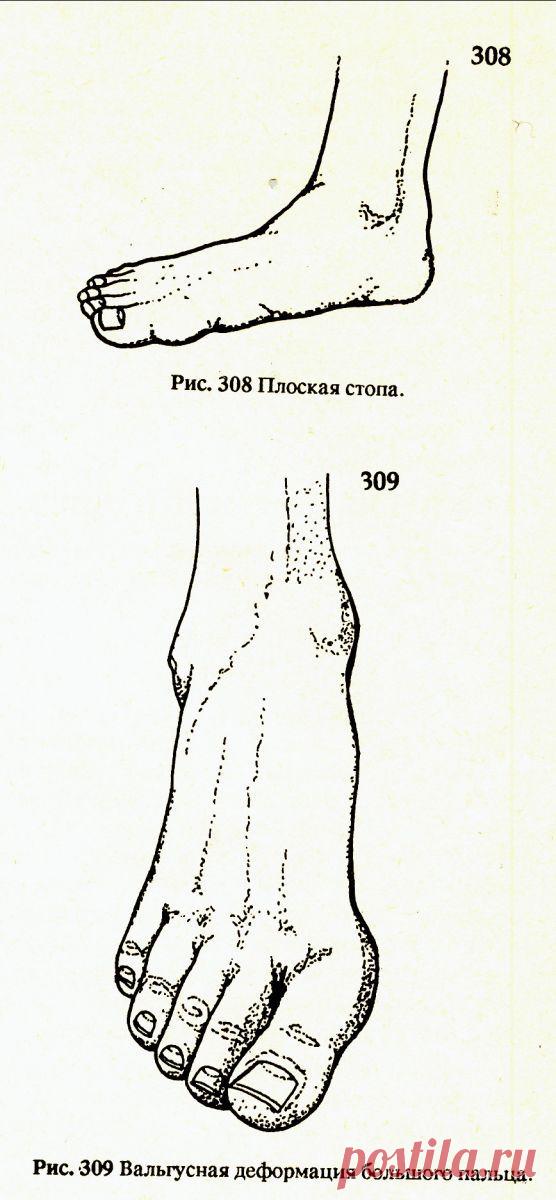 Мануальная терапия при патологии "халюс-вальгус". | Официальный сайт Л. Розломия | Розломий Леонид Кононович