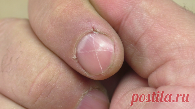 Долго мучался с заусенцами на пальцах, спасибо бабушке, рассказала о 