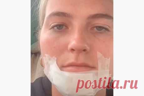 Женщина поцеловала бородатого мужчину и осталась с волдырями на лице. Блогерша поцеловала мужчину с растительностью на лице поделилась неудачным опытом. На размещенных в сети кадрах Ханна Уиттс (Hannah Witts) объяснила, что сходила на свидание с молодым человеком, у которого была борода. По ее словам, после поцелуя с ним на ее подбородке образовалось большое количество волдырей.