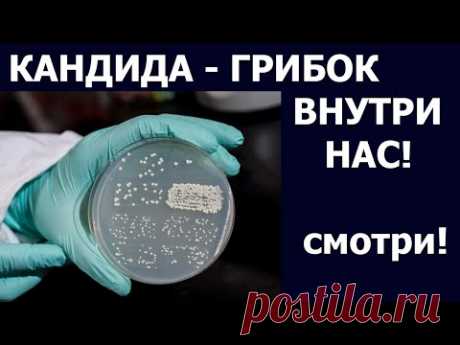 Грибки КАНДИДА ГРИБОК ВНУТРИ НАС. СИМПТОМЫ КАНДИДОЗА У МУЖЧИН И ЖЕНЩИН. Питание при кандидозе.