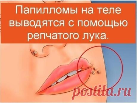 ОТ БОЛЕЗНИ ИЗЛЕЧИЛСЯ САМ

Папилломы на теле выводятся с помощью репчатого лука.

Нужно, срезав верхнюю часть, сделать в луковице отверстие, засыпать туда чайную ложку соли и оставить до утра. Утром слить из луковицы образовавшийся сок и смазать им папилломы.

Делать так до тех пор, пока кожные образования не начнут исчезать.

Совет травника

Микроспорию — лишай, подхваченный от собак и кошек, довольно успешно излечивают домашним способом:

- разрезают на две дольки кишмиш ...