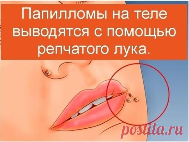 ОТ БОЛЕЗНИ ИЗЛЕЧИЛСЯ САМ

Папилломы на теле выводятся с помощью репчатого лука.

Нужно, срезав верхнюю часть, сделать в луковице отверстие, засыпать туда чайную ложку соли и оставить до утра. Утром слить из луковицы образовавшийся сок и смазать им папилломы.

Делать так до тех пор, пока кожные образования не начнут исчезать.

Совет травника

Микроспорию — лишай, подхваченный от собак и кошек, довольно успешно излечивают домашним способом:

- разрезают на две дольки кишмиш ...