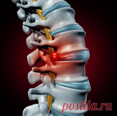 Народный способ, при лечении от грыжи межпозвоночного диска с рецептом из 3 простых ингредиентов 
Межпозвоночная грыжа может появиться не только в результате травм или чрезмерных физических нагрузок, но и как следствие малоподвижного, сидячего образа жизни.
Врачи считают грыжу опасным заболевание…