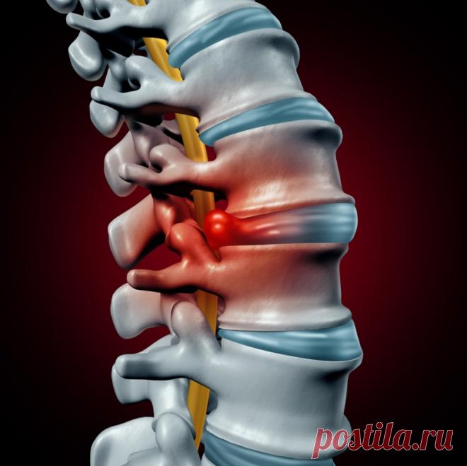 Народный способ, при лечении от грыжи межпозвоночного диска с рецептом из 3 простых ингредиентов 
Межпозвоночная грыжа может появиться не только в результате травм или чрезмерных физических нагрузок, но и как следствие малоподвижного, сидячего образа жизни.
Врачи считают грыжу опасным заболевание…