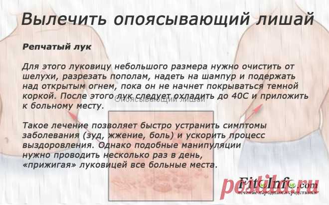 Вылечить опоясывающий лишай