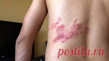 Опоясывающий лишай (герпес): лечение, симптомы с фото, причины Лечение опоясывающего лишая у взрослых. Симптомы и причины опоясывающего лишая.