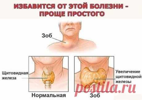 Проще простого: йод, хвойный отвар и лавровый лист. Бабушкины рецепты.
Мне уже 76 лет, много пережито и испытано в жизни, столько болезней перенесла. Вот и хочу поделиться опытом. Как я излечила зоб. Выросла я на реке Ангаре, в воде которой очень мало йода. Наверное, в этом одна из причин того, что зоб - довольно распространенное заболевание среди жителей тех краев. Когда попала в Иркутскую областную клинику на консультацию к эндокринологу, то, увидев больных с нарушением щитовидной железы, при