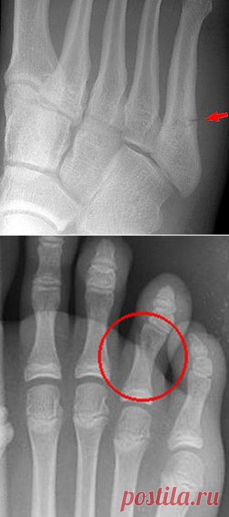 Переломы костей стопы - причины, симптомы, диагностика и лечение