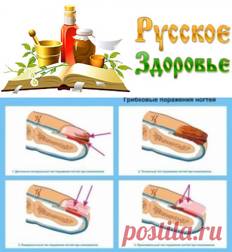 Как вылечить грибок на ногтях?