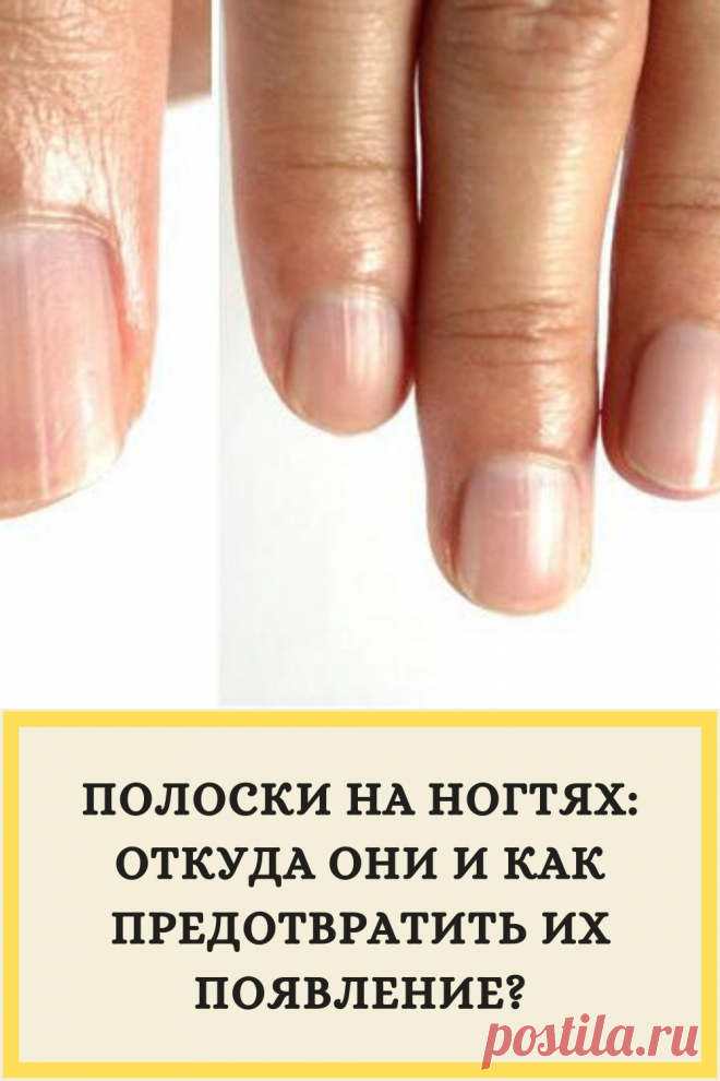 Полоски на ногтях: откуда они и как предотвратить их появление?