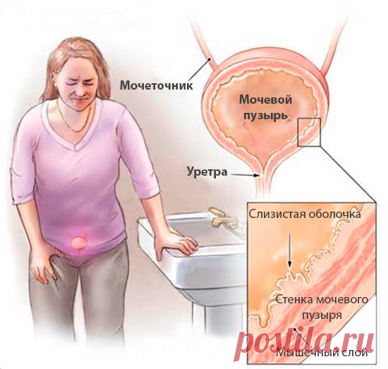 Как лечить цистит? | Сто хитростей