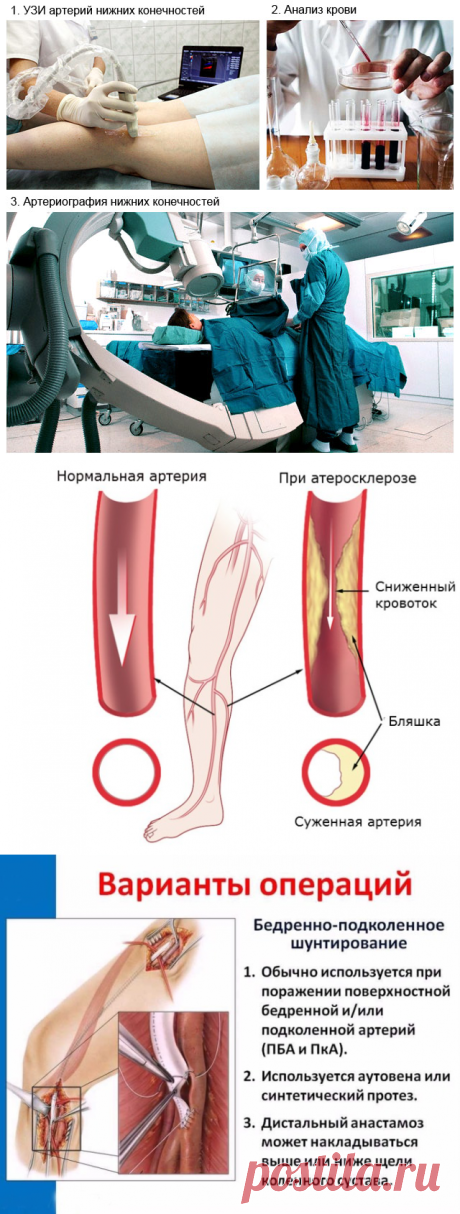 Атеросклероз сосудов нижних конечностей: какие симптомы и лечение