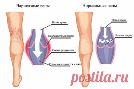 Самые эффективные упражнения против варикоза 


Не стоит думать, что варикоз — это чисто «женская болезнь», ведь варикоз случается и у мужчин.







 


Самый надежный способ борьбы с варикозным расширением вен – это упражнения. Кроме того, нео…