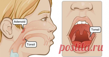 Предотвращаем болезни! Очищаем миндалины / Будьте здоровы