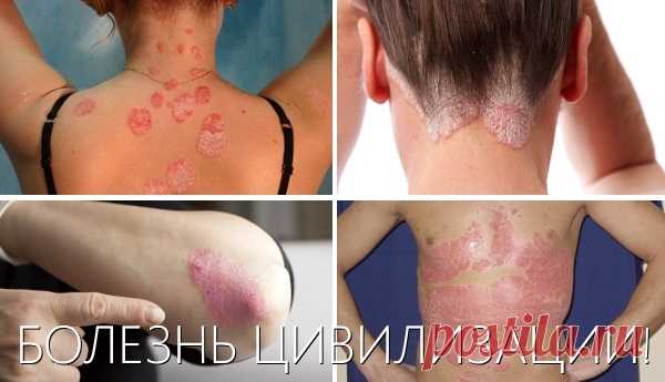 Народная медицина в лечении псориаза: лечимся дома, без боли и проктологов


Псориаз - болезнь всего организма: это грязная кровь – больная печень - плохая усвояемость пищи - измученная иммунная система.По данным ВОЗ, в настоящее время от псориаза страдает 2-4% населения планеты.Не так много, не правда ли? Но если в этот маленький процент попали именно ВЫ… Читайте далее, и Вы узнаете как лечить псориаз.